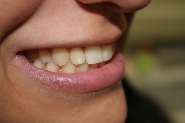 Bei Bechterew sind Zahnfleischprobleme nicht selten